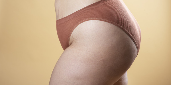 Tłuszcz na nogach – jak się go pozbyć?