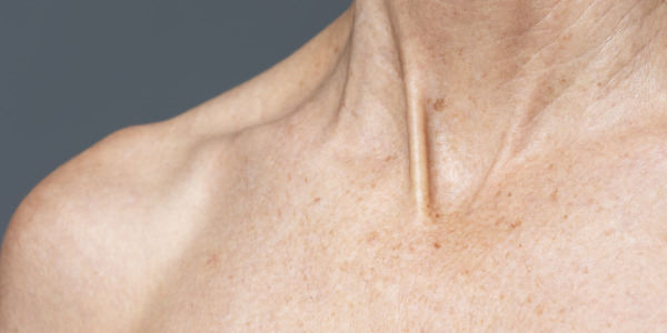 Zmarszczki na dekolcie – skuteczne sposoby